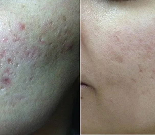 RF Microneedling behandlingsresultat