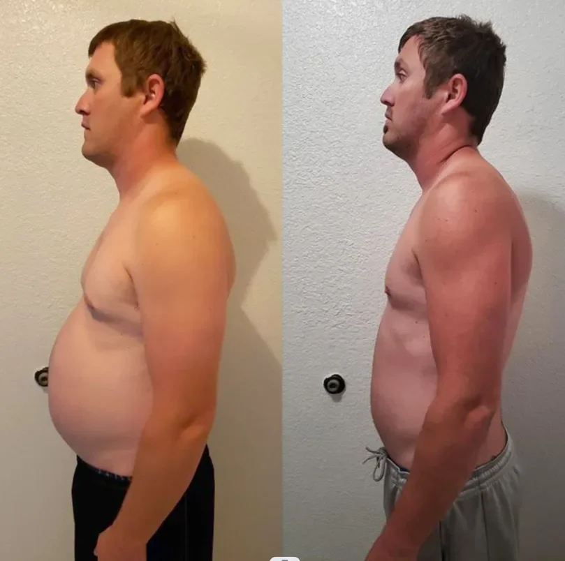HIFU behandling – ansiktslyft