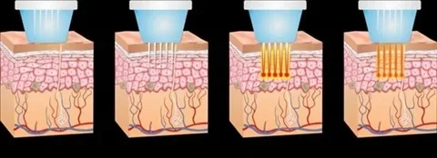 Microneedling – RF microneedle-behandling